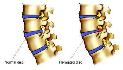 disc herniation, blown disc, ruptured disc, radicular pain